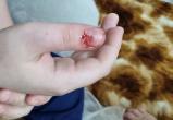 В Ноябрьске собака цапнула ребенка за палец (ФОТО)