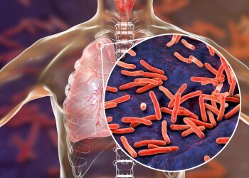 Что нужно знать о туберкулезе