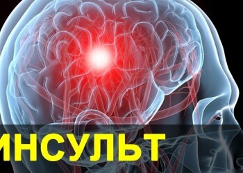  Как не допустить развития инсульта