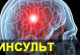  Как не допустить развития инсульта